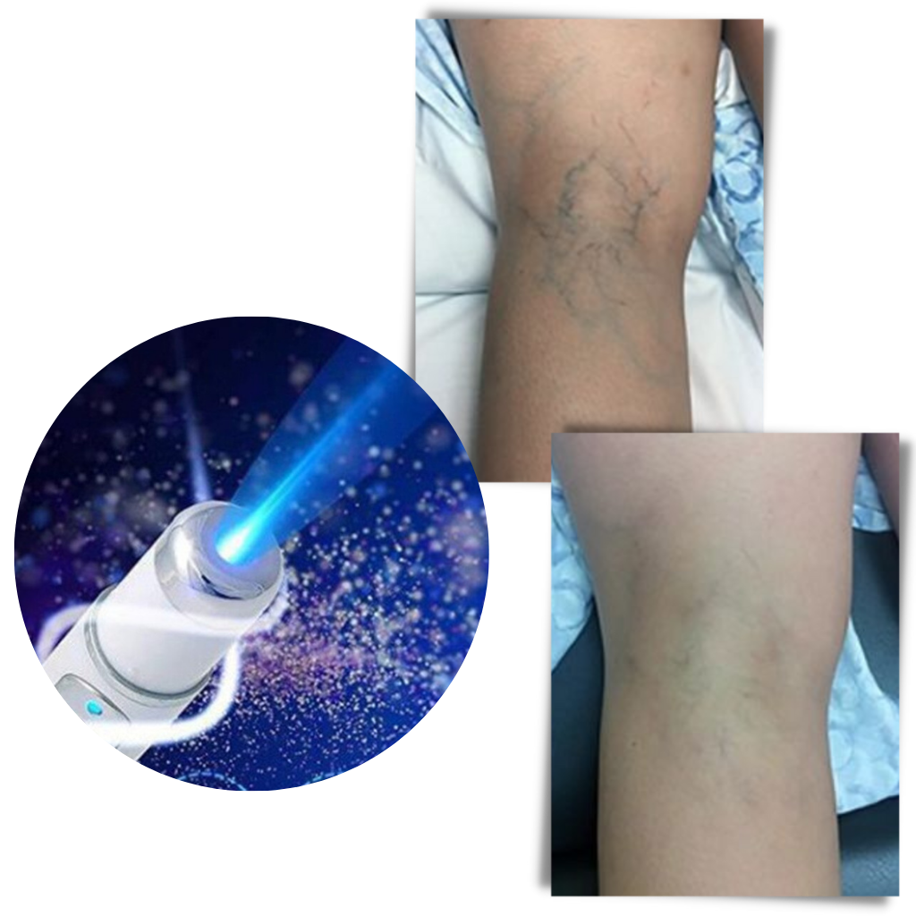 Stylo de thérapie de la peau à la lumière bleue
