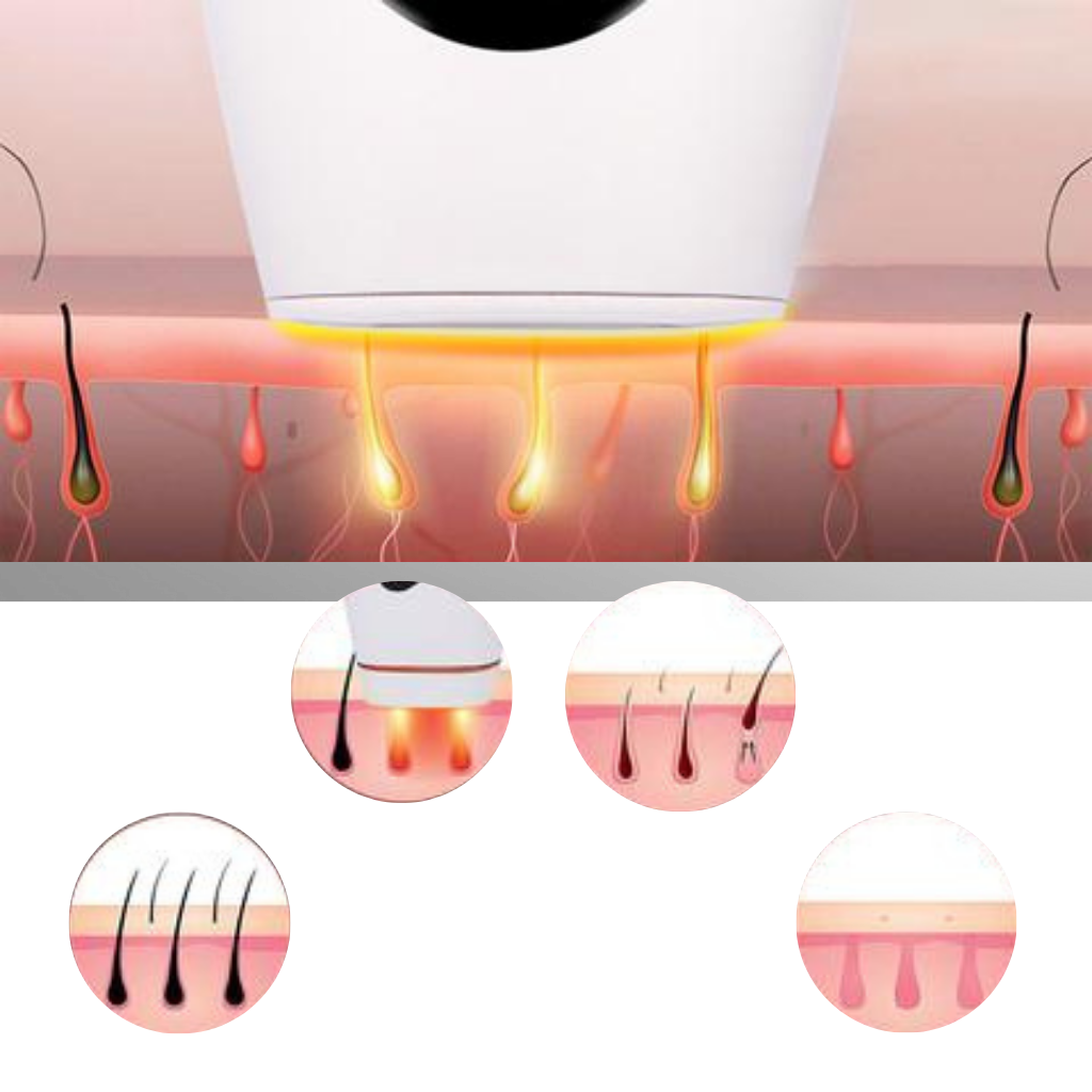 Appareil d'épilation laser IPL